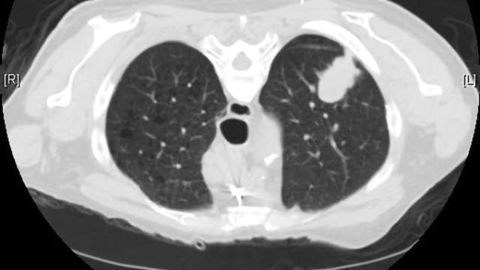 Expanding Lung Cancer Screening Poses Serious Challenges