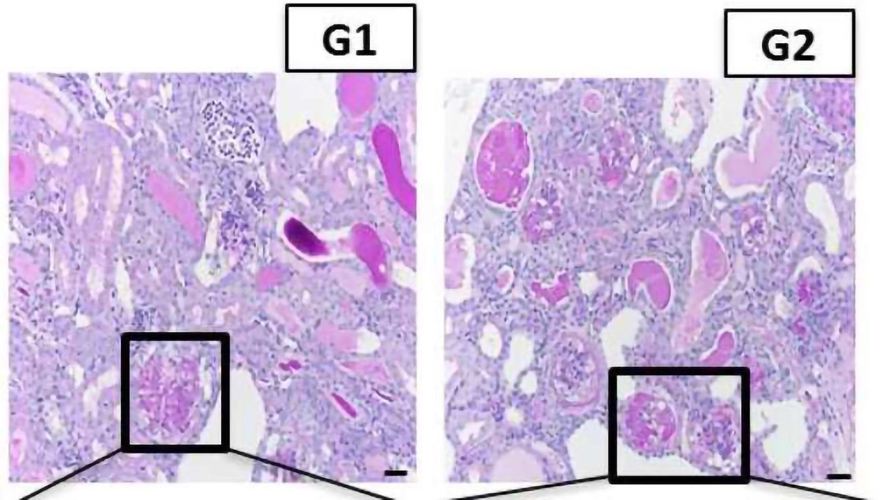 African Americans Have Heightened Risk of Kidney Disease