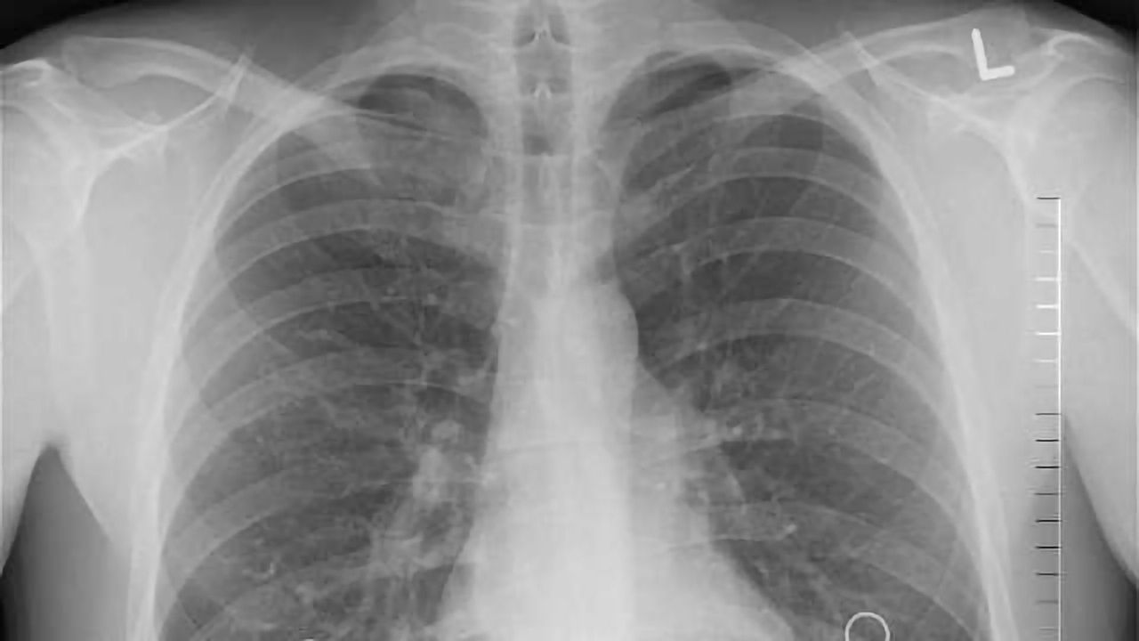 Irisin Linked to Mechanisms for Bone Metabolism