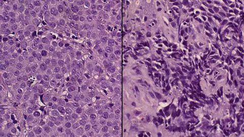 Seeking Out and Destroying Cancer