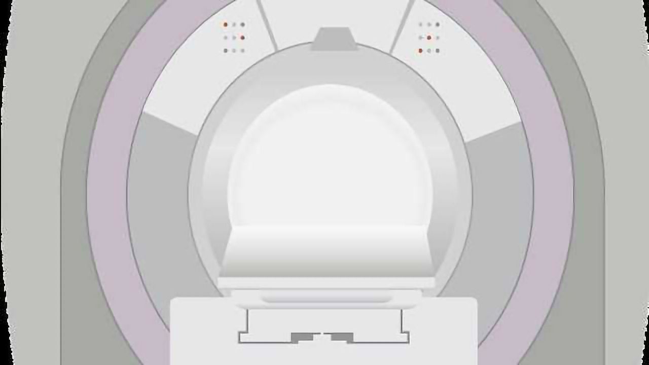 MRI Scan Spots HIV in the Brain