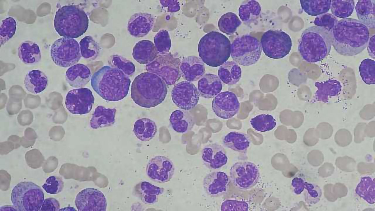 Resetting Gene Expression Shows Promise as Cancer Treatment