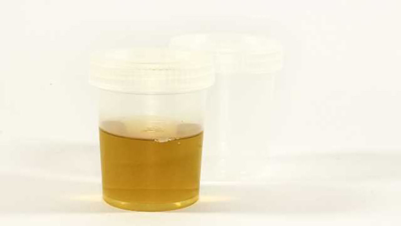 Urine Biomarker Tracks ALS