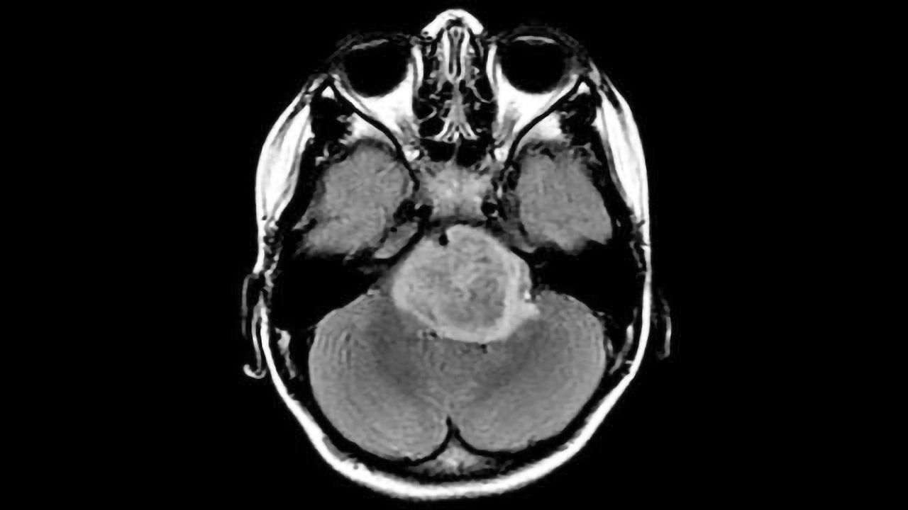Key Differences Revealed Between Major Brain Cancer Types