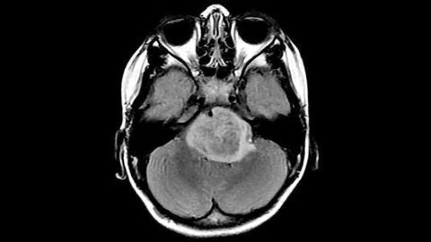 Key Differences Revealed Between Major Brain Cancer Types