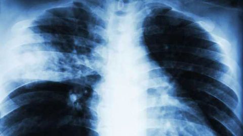 New Screening Method for Tuberculosis Drugs