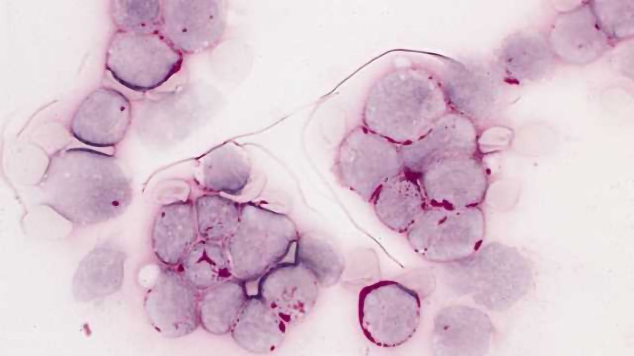 Leukemia Drug Posts Promising Results in Key Trial