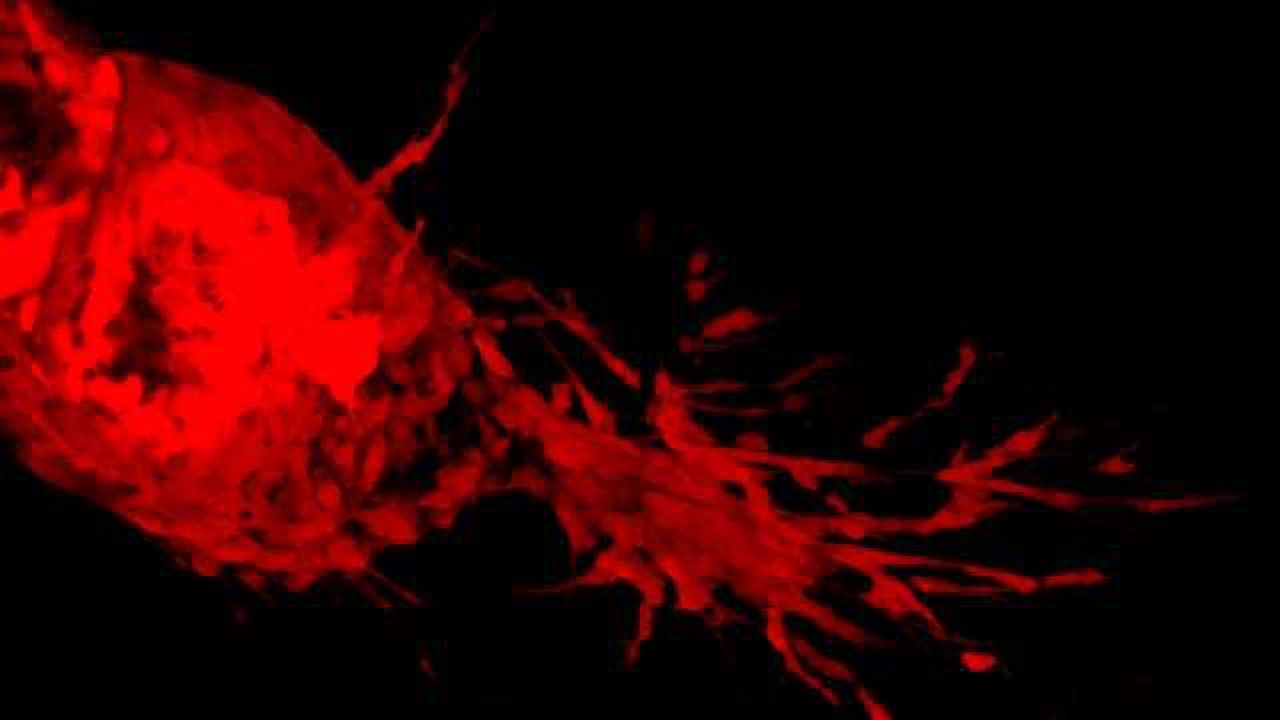 SMARCE1 Linked to Aggressive Early Stage Breast Cancer
