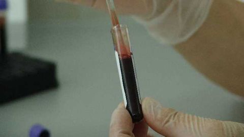 New Gene-Based Blood Test for Skin Cancer