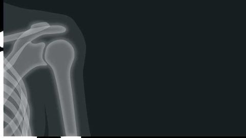 Regenerating Rotator Cuffs with Stem Cells