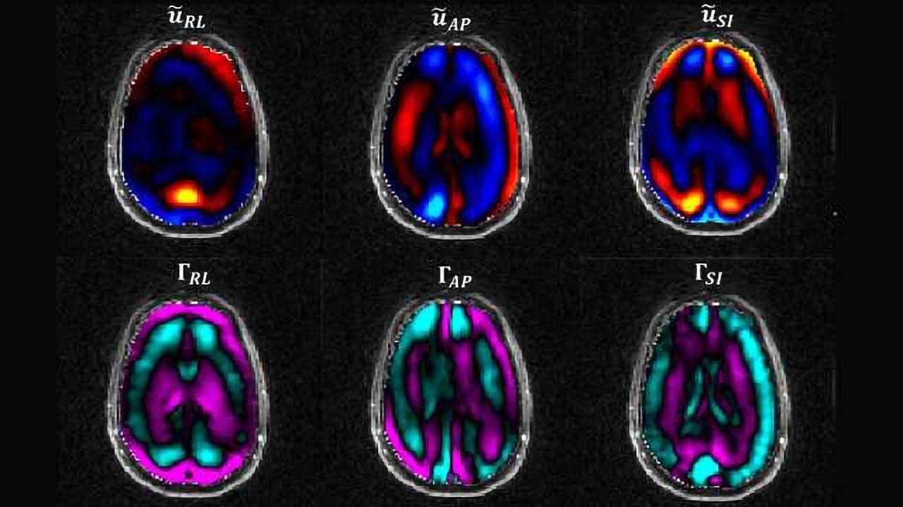 Studying the Brain’s Suspension System in TBIs