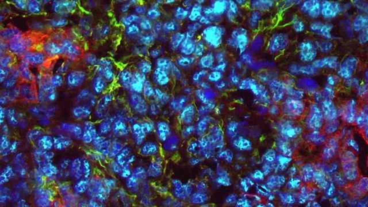 T-cell Therapy for Ovarian Cancer Shows Promise