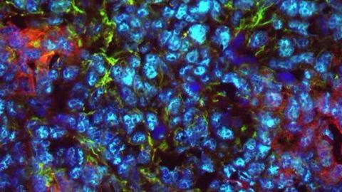 T-cell Therapy for Ovarian Cancer Shows Promise