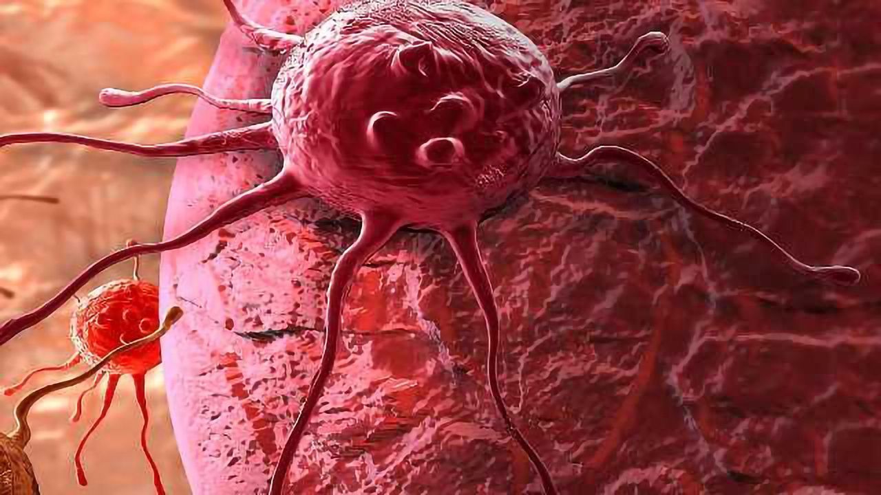 A Biomarker for Prostate Cancer Progression