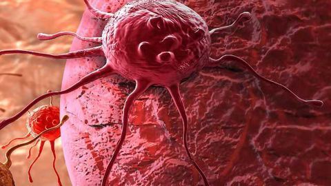 A Biomarker for Prostate Cancer Progression