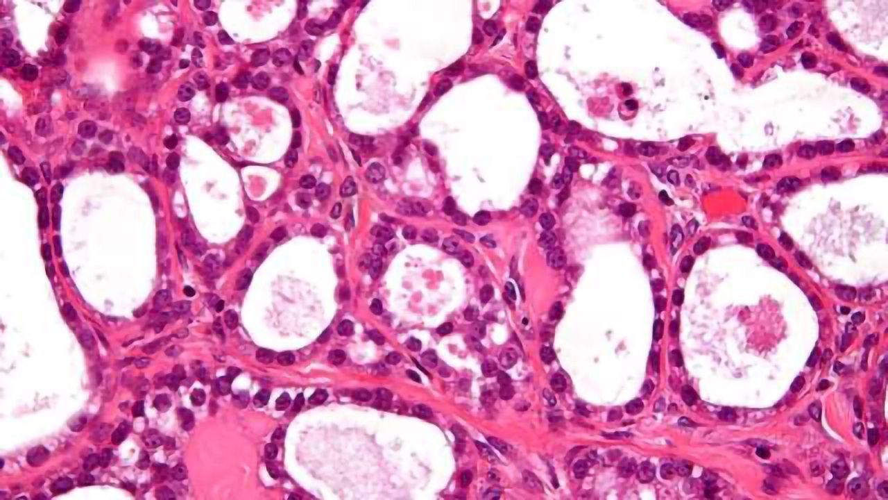 New Technology can Detect Tiny Ovarian Tumors