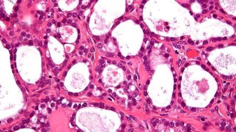 New Technology can Detect Tiny Ovarian Tumors