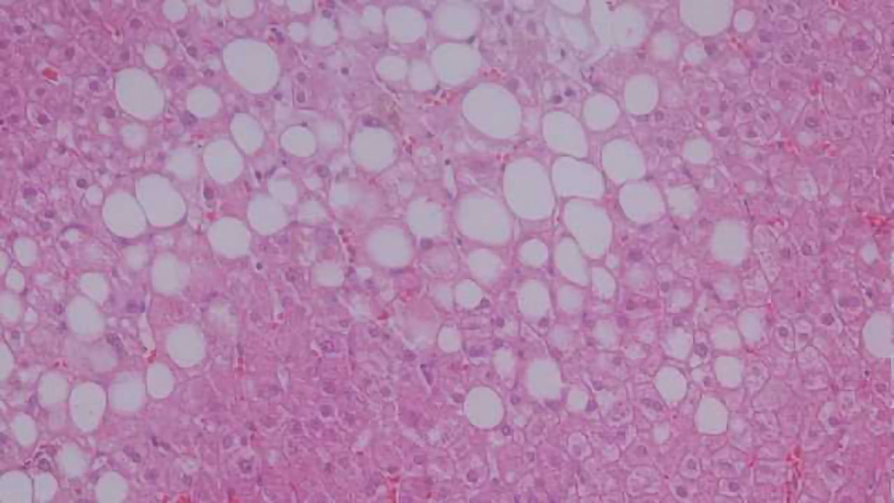 Accurate, Non-invasive Fatty Liver Diagnosis