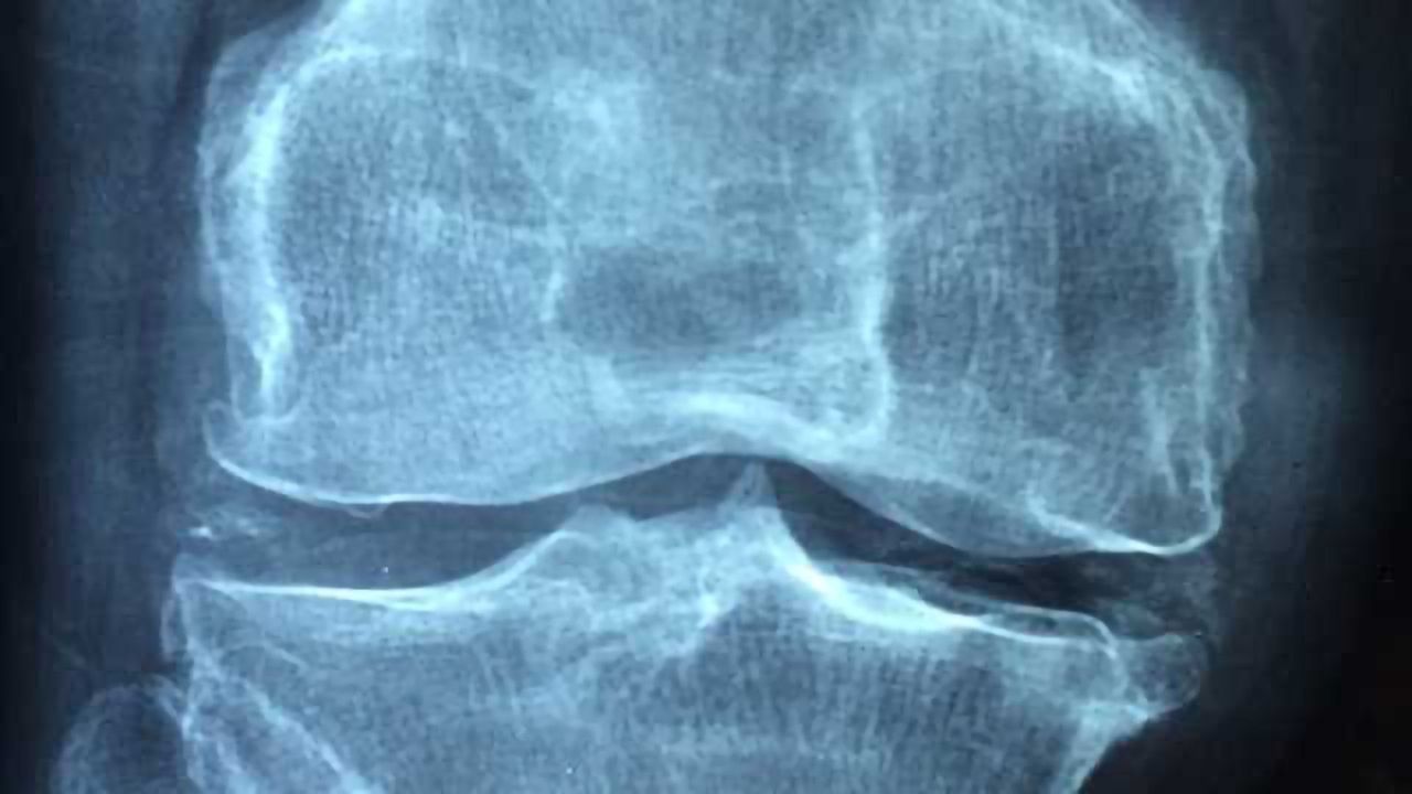 High-Fat, High-Carb Diet a Cause of Osteoarthritis
