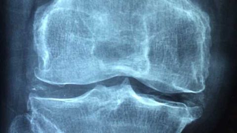 High-Fat, High-Carb Diet a Cause of Osteoarthritis