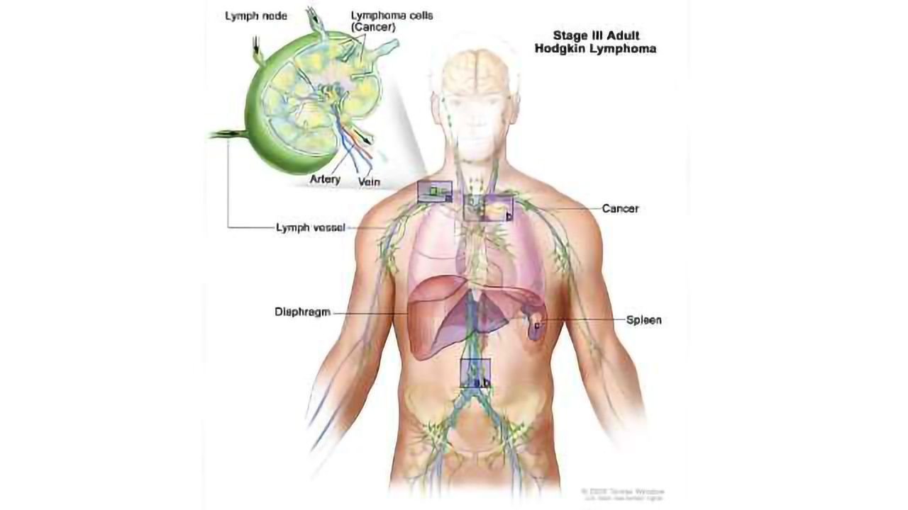FDA Approves Pembrolizumab for Hodgkin Lymphoma