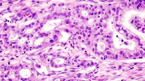 Key Factor for Pancreatic Cancer Aggressiveness Identified