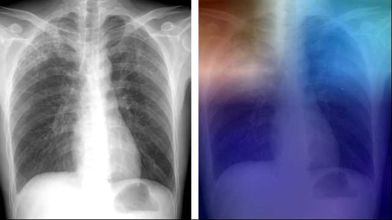 AI Could Help Diagnose TB in Remote Areas