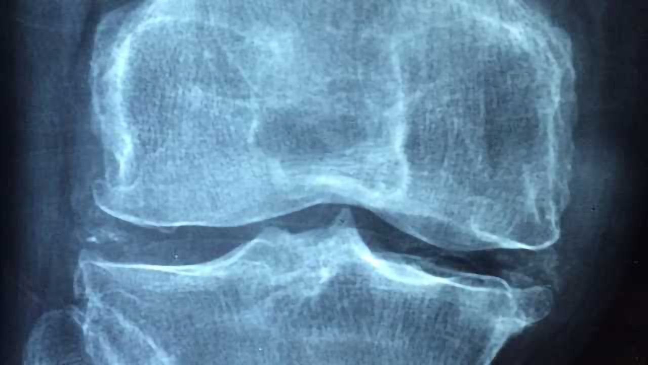 Removing Old Cells Could Prevent Joint Degeneration