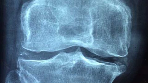 Removing Old Cells Could Prevent Joint Degeneration