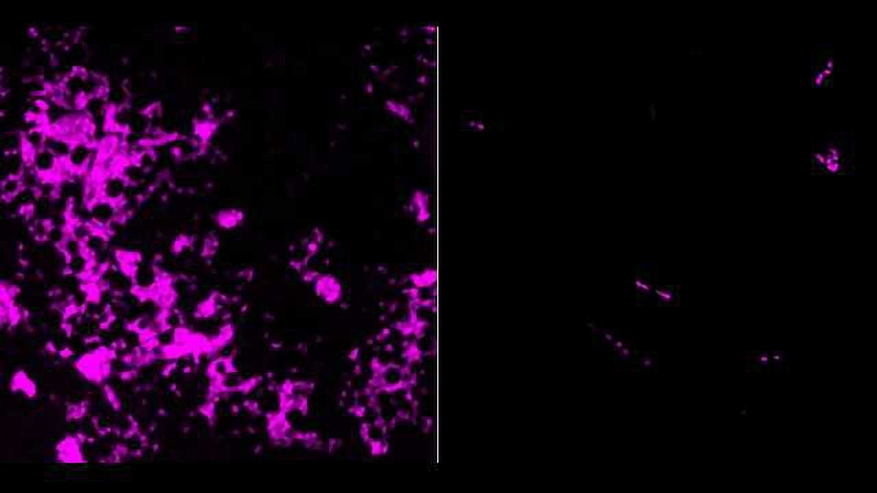 Treating Solid Tumors with T-cells