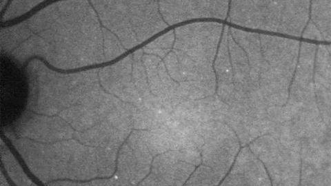 New Technique Can Diagnose Glaucoma Earlier