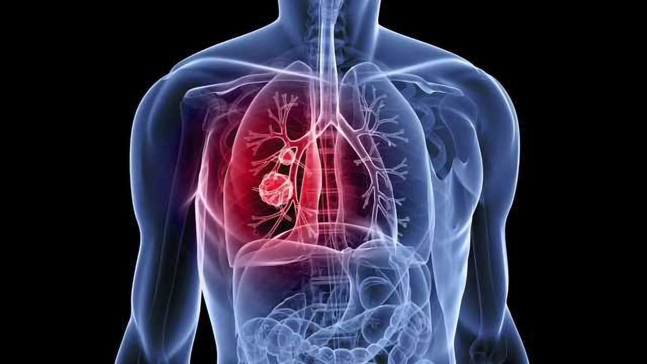 Stopping Early Stage Lung Cancer in its Tracks