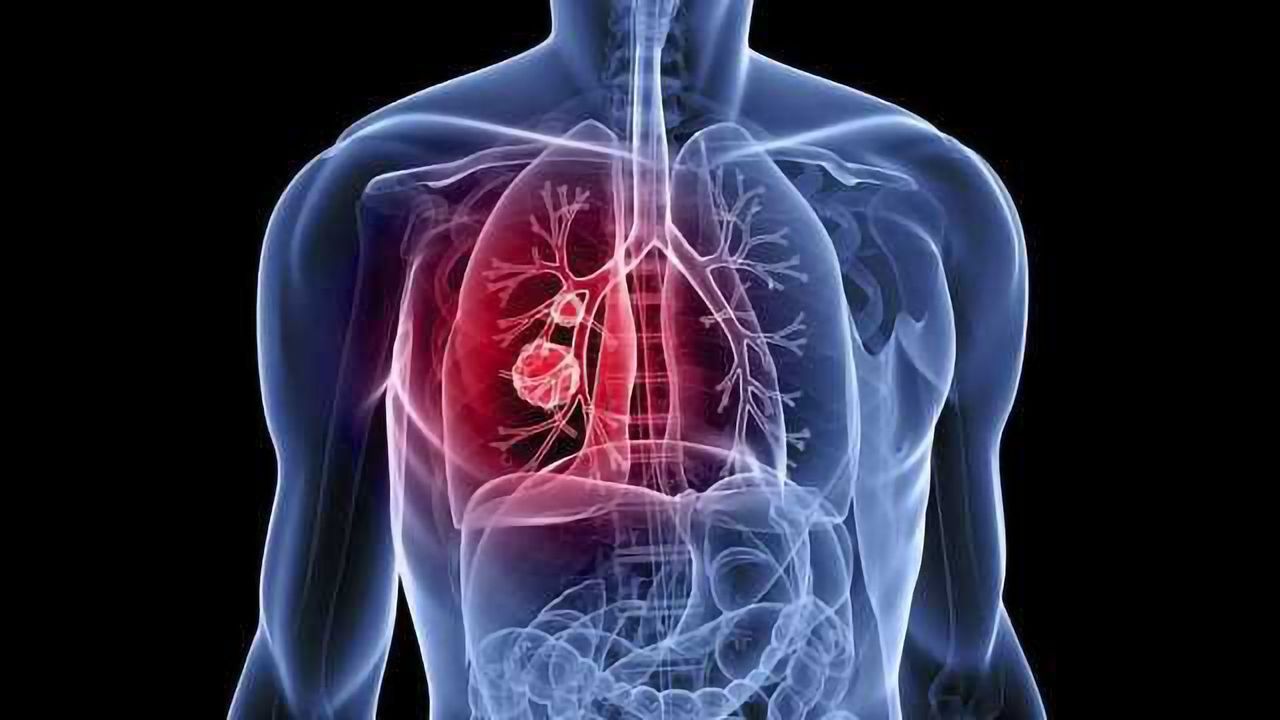 Cancer in Lungs X Ray - What Is It?