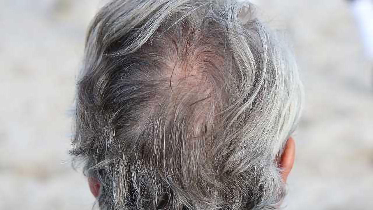 Cells Responsible for Gray Hair and Balding Identified