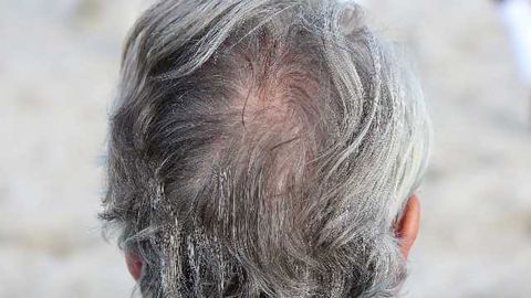 Cells Responsible for Gray Hair and Balding Identified