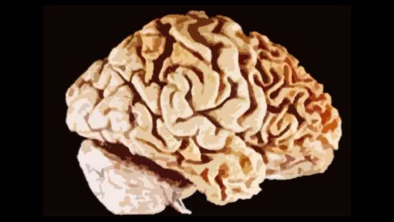 Reduction in Progranulin Linked to Frontotemporal Dementia