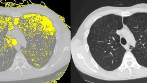 HIV Destroys Lung Tissue by Reprogramming Airway Stem Cells