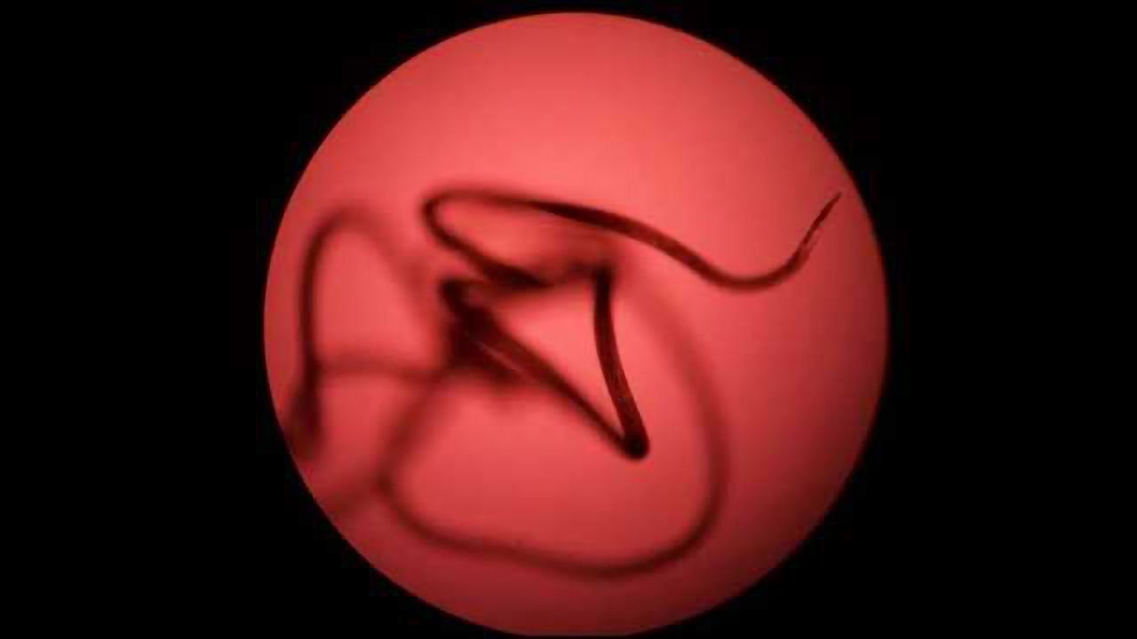 New RNAi Method May Help Us Beat Elephantiasis