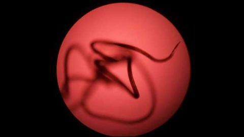 New RNAi Method May Help Us Beat Elephantiasis