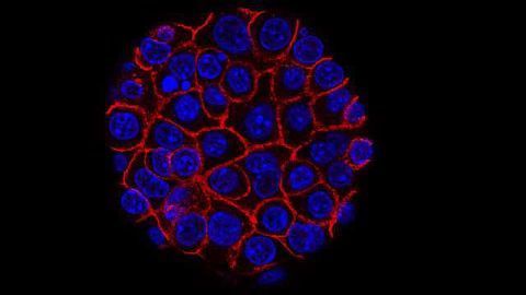 Potential Biomarker for Aggressive Prostate Cancer Identified