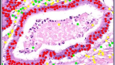 Cancer Cells Detected More Accurately in Hospital with AI