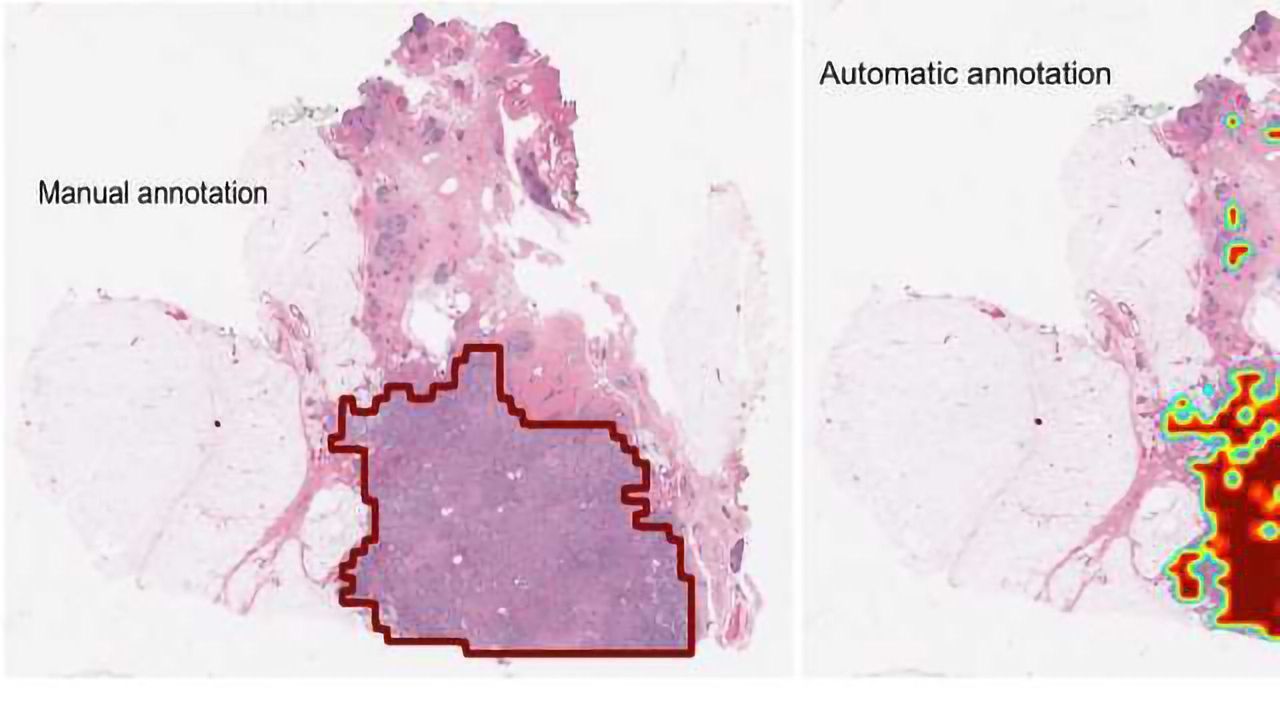 Computer Accurately Identifies Breast Cancers on Digital Tissue Slides