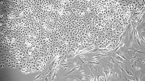 How Cancer Cells Flood the Lungs
