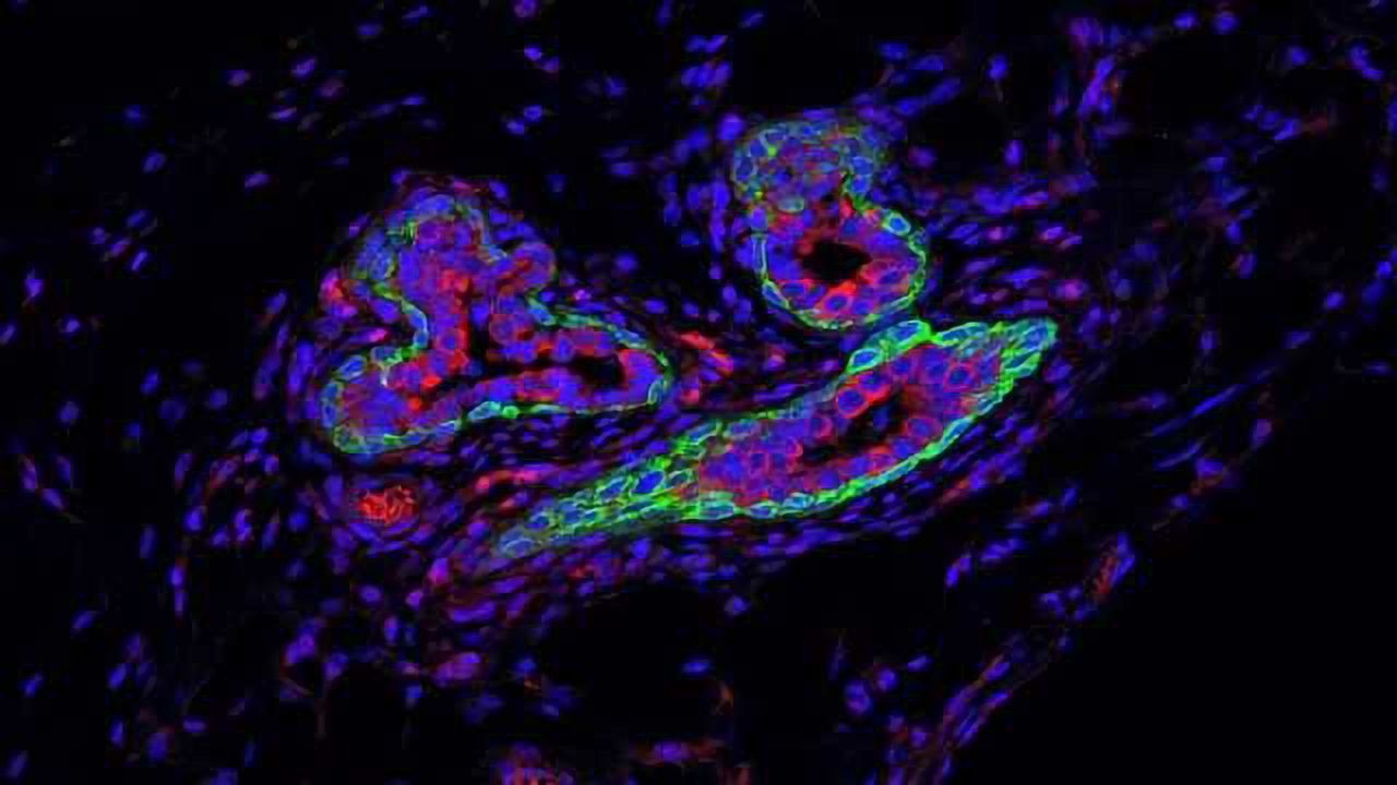 RNA Molecule that Shields Breast Cancer Stem Cells from Immune System Identified