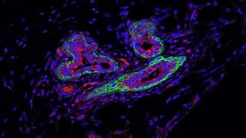 RNA Molecule that Shields Breast Cancer Stem Cells from Immune System Identified