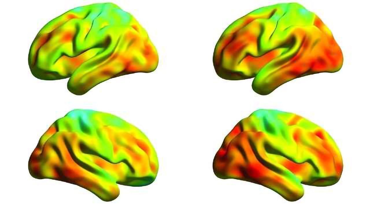 Tau Protein Spread in Brains of Alzheimer's Disease Measured