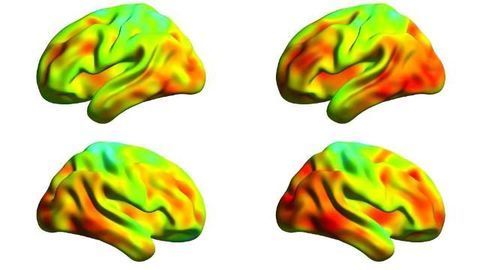 Tau Protein Spread in Brains of Alzheimer's Disease Measured