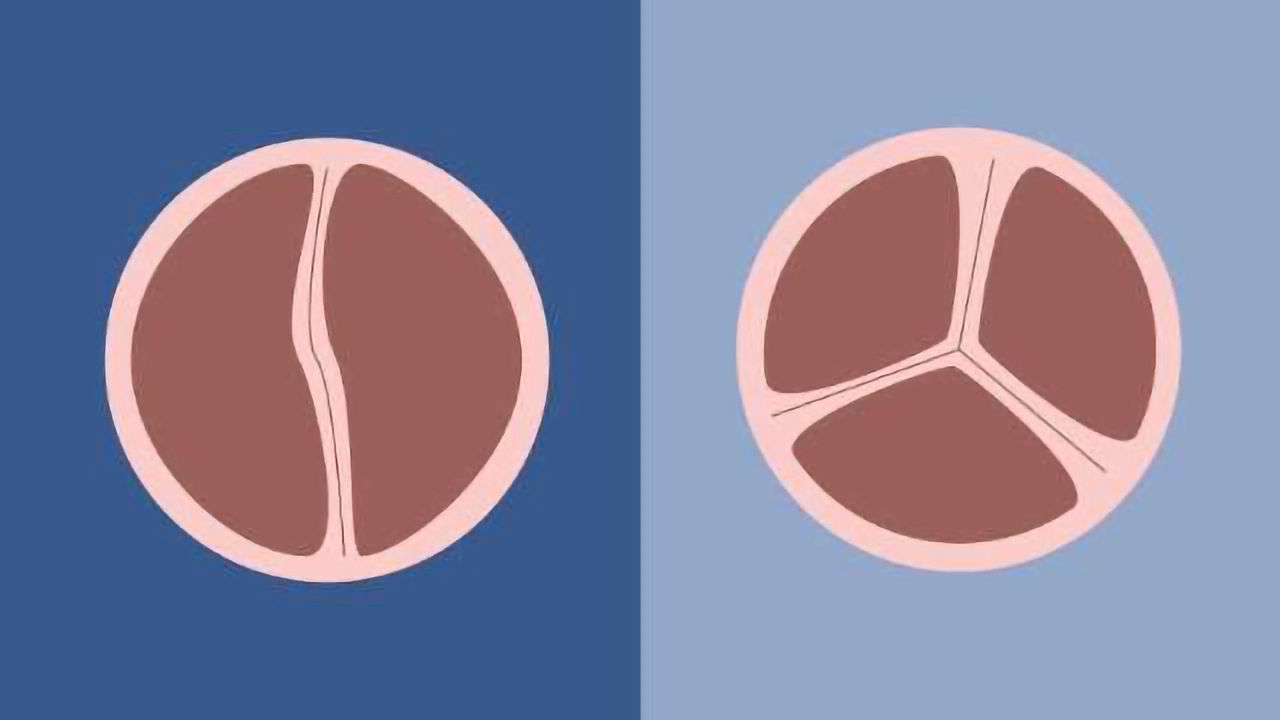 2 Gene Variants Linked to Most Common Congenital Heart Defect