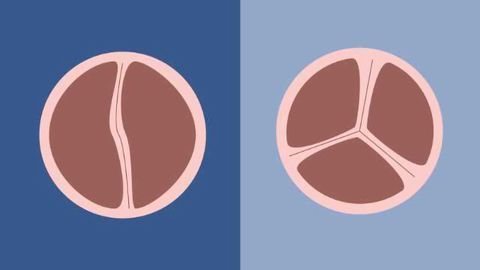 2 Gene Variants Linked to Most Common Congenital Heart Defect