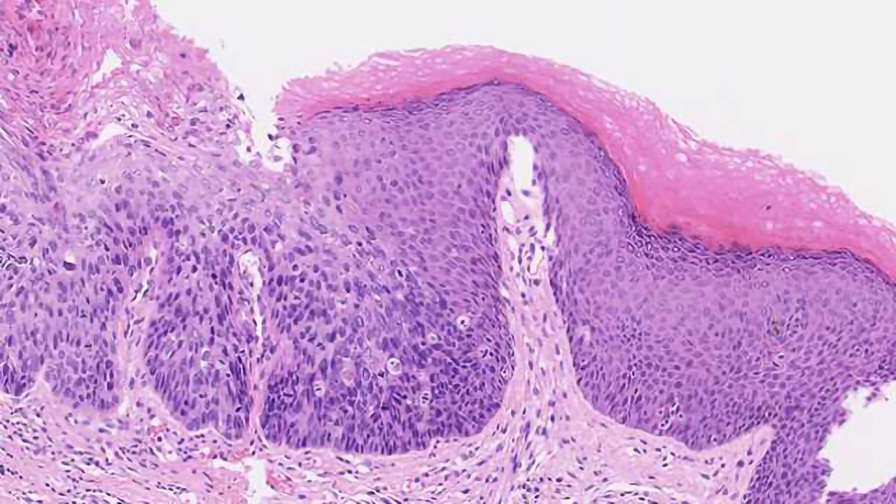 Epigenetic Markers May be Used to Estimate Anal Cancer Risk